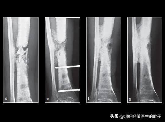 胫腓骨骨折术后七个月，恢复、挑战与希望