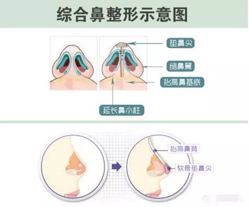 鼻综合手术两个月后鼻头仍然很大的原因及应对策略