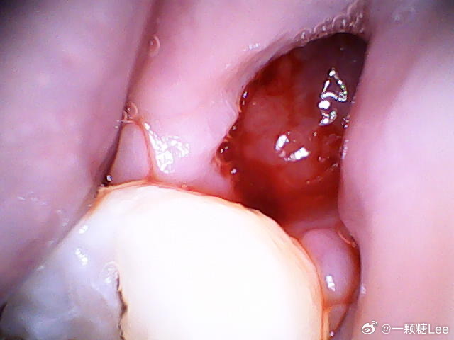 拔牙半个月后牙洞弄出血，原因、处理与预防措施